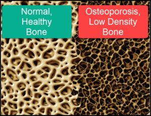 Opsteoporosis Bone Density