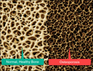 Osteoporosis & Bone Density